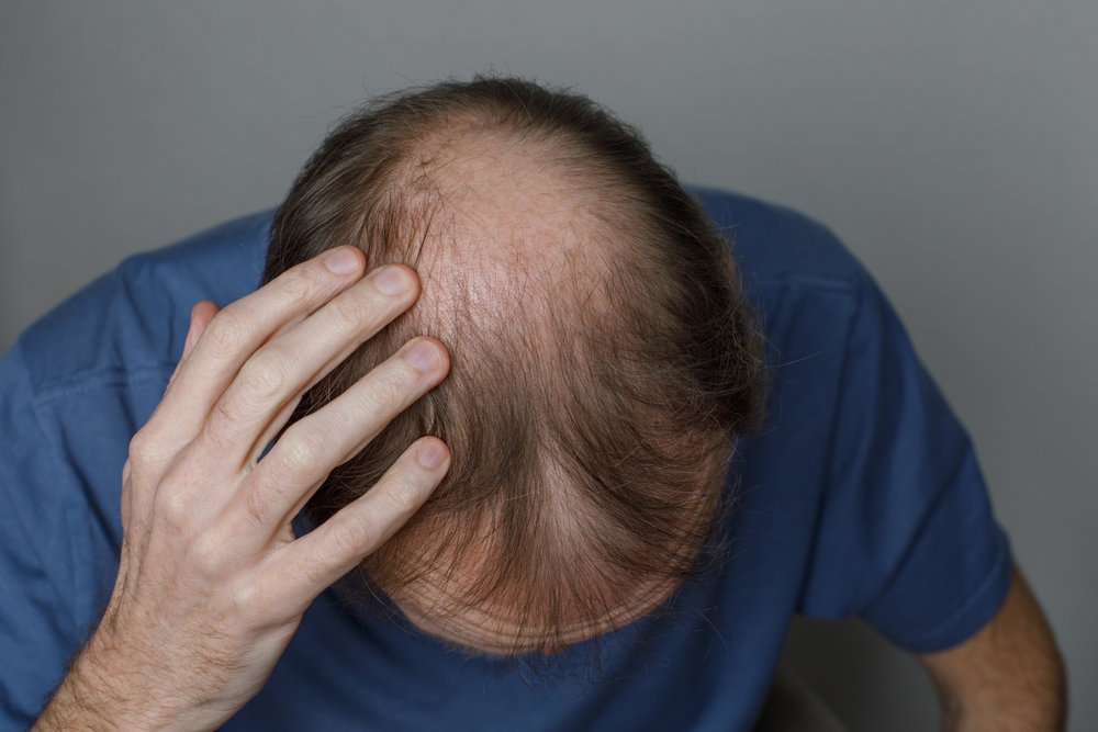Mature,Male,Head,With,Thin,Hair,On,His,Top,Head